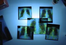 Заболеваемость туберкулезом в Рыбнице снизилась в 2022 году Туберкулёз, заболеваемость