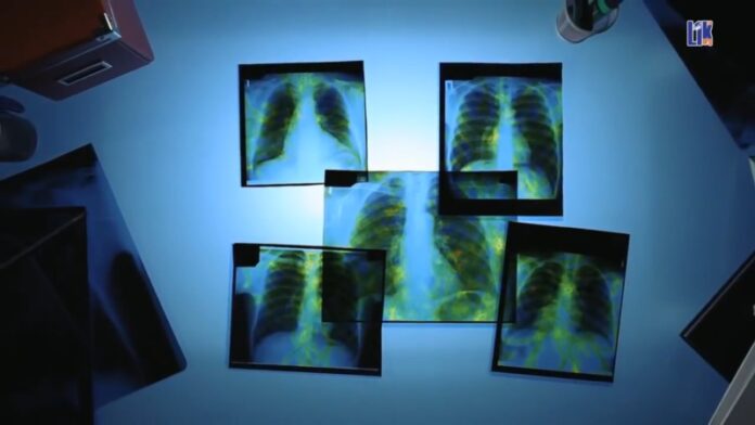 Заболеваемость туберкулезом в Рыбнице Туберкулёз, заболеваемость