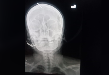 Беременная женщина в Пакистане вбила гвоздь себе в голову, чтобы родить мальчика Беременная женщина в Пакистане забила гвоздь себе в голову _ фото dawn.com