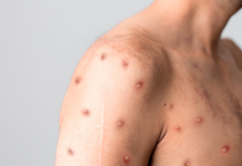 Оспа обезьян нагрянула в Молдову: первый случай обезьян оспой Молдову