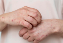 В Молдове зафиксировано несколько случаев заболевания корью корь