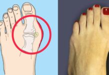 Как избавиться от выпирающей косточки на пальце ноги и откуда она берётся косточки на большом пальце ноги