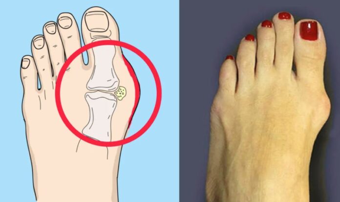 косточки на большом пальце ноги