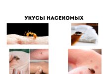 Если вас укусили насекомые, обратите внимание Укусы насекомых