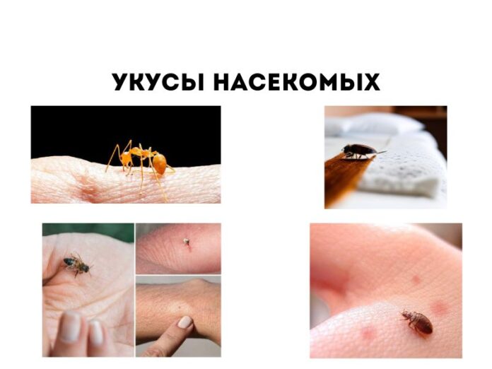 Укусы насекомых