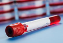 Борьба с ВИЧ и гепатитами: в Приднестровье увеличили охват тестирования и лечения ВИЧ, гепатит, анализы, пробирки, Минздрав