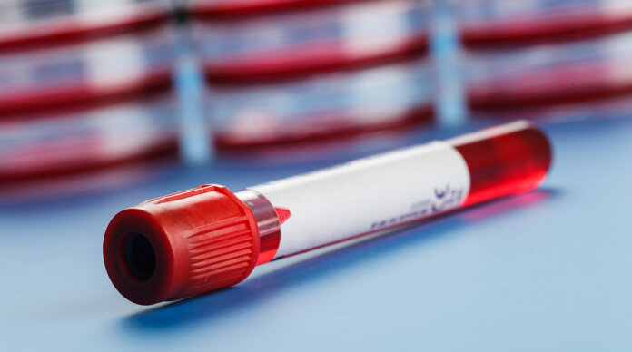 ВИЧ, гепатит, анализы, пробирки, Минздрав